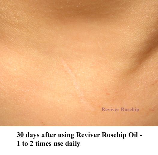 Reviver tm Rosehip Seed Oil penetrates the skin quickly, has 